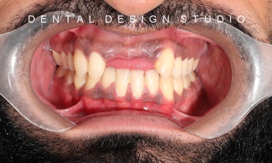 dentist in cancun before and after